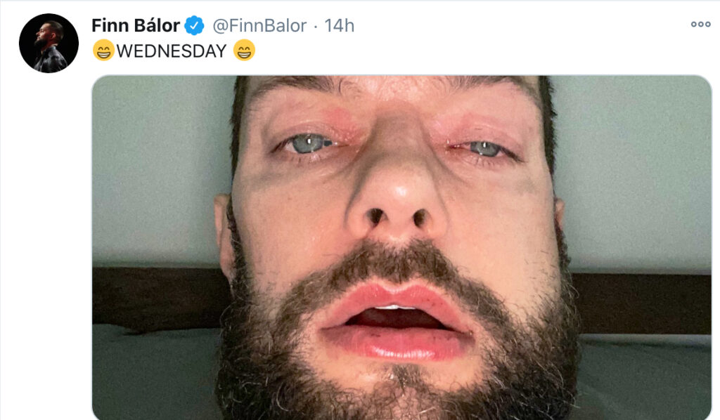 Finn Bálor: aggiornamenti sul suo infortunio