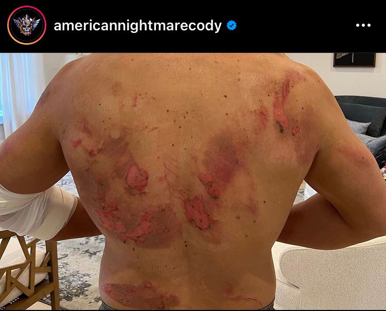 Cody Rhodes mostra la schiena dopo AEW Dynamite