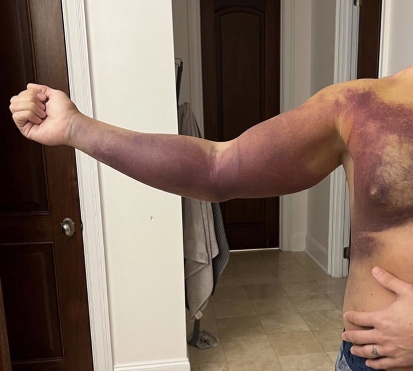 Cody Rhodes: le immagini delle conseguenze dell'infortunio